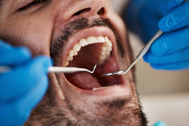 Best Emergency Tooth Extraction in Forest Hill, TX